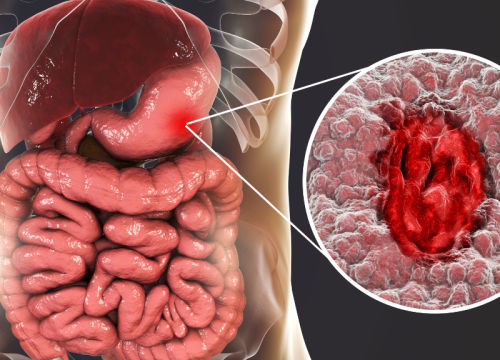Gestric Sleeve Resection In Indore By Dr. Abhyudaya Verma Gestric Sleeve Resection In Indore By Dr. Abhyudaya Verma