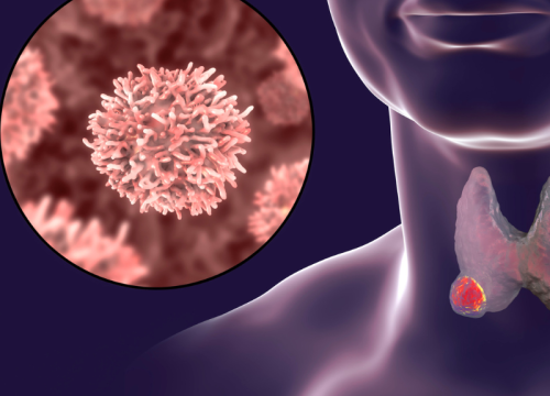 Thyroid Cancer Treatment In Indore By Dr. Abhyudaya Verma Thyroid Cancer Treatment In Indore By Dr. Abhyudaya Verma