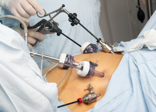 gestric bypass surgery In Indore By Dr. Abhyudaya Verma gestric bypass surgery In Indore By Dr. Abhyudaya Verma