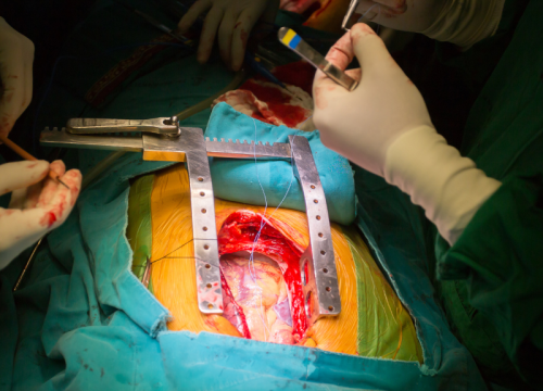 mini gestric bypass In Indore By Dr. Abhyudaya Verma